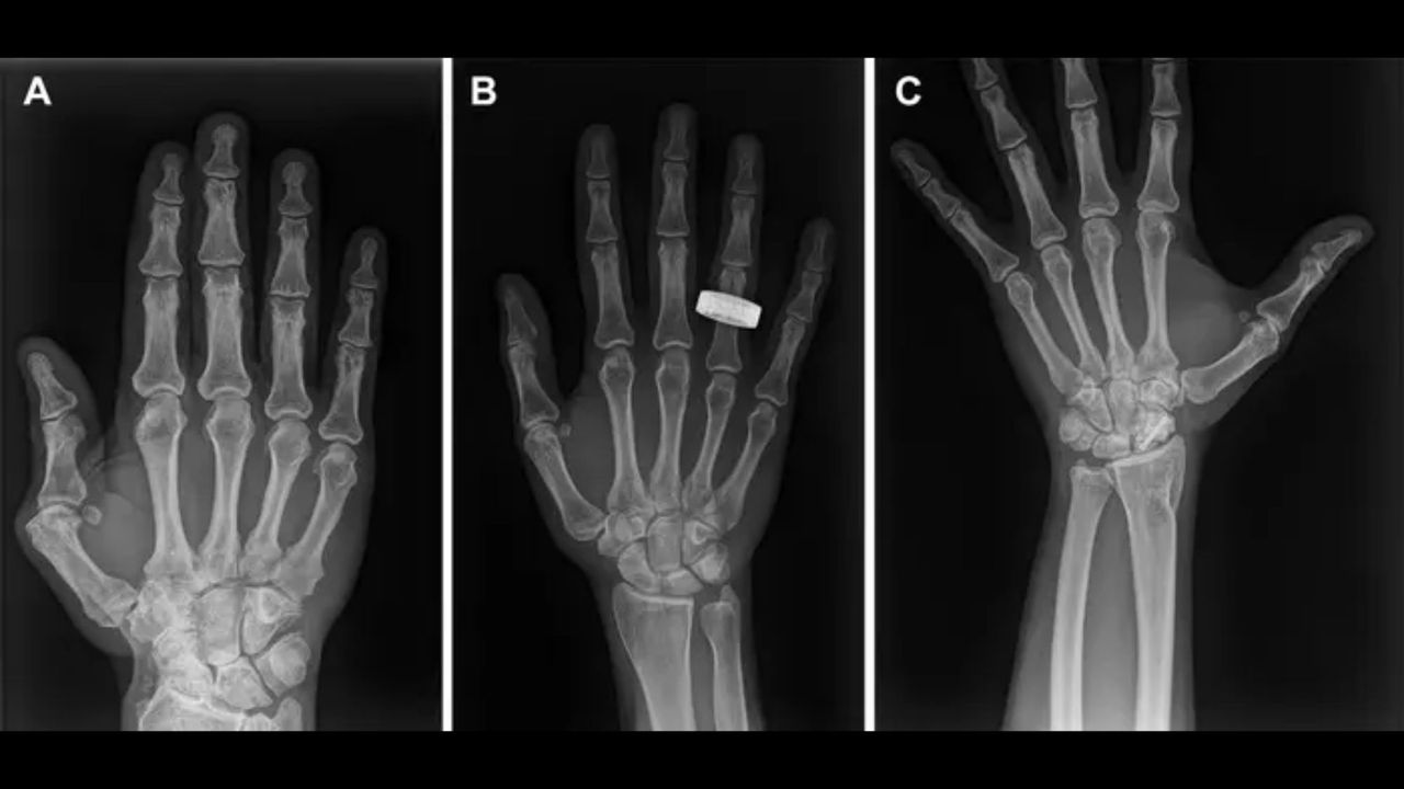  1st-ever X-rays in space offer hope for possible patients headed to the moon 